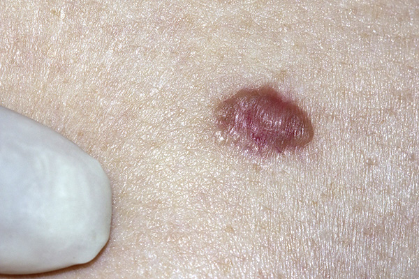 Basal cell carcinoma