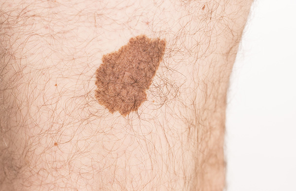 Melanoma